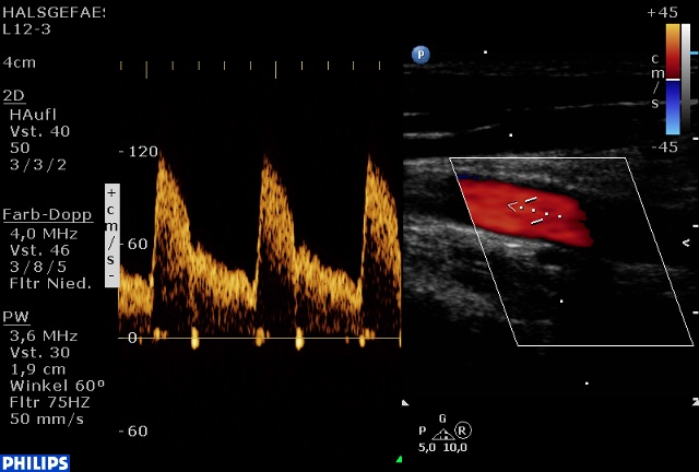 Sonographie der Gefäße (Doppler- und Duplexsonographie)